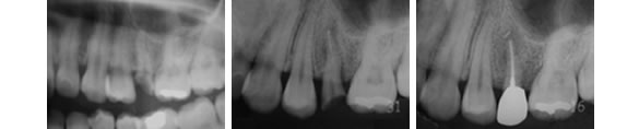 歯牙移植のレントゲン