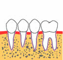 歯牙再植-4