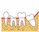 歯牙移植-1