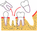 歯牙移植-2